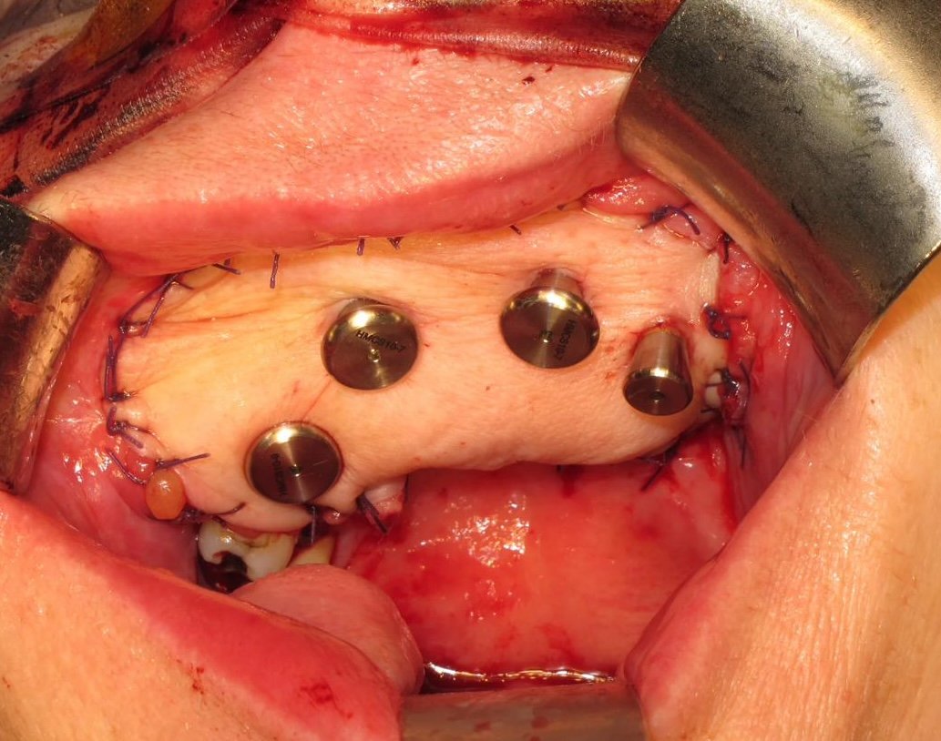 ZIP Flap surgical procedure