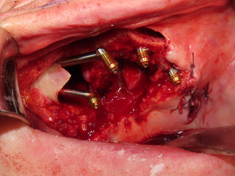 Zygomatic Implant Placement - Installing oncology implants