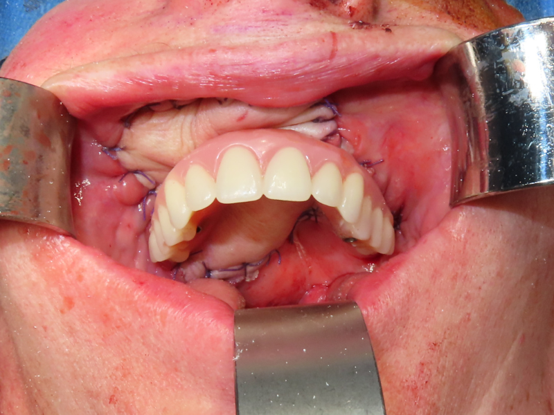 Prosthesis Fabrication - Fixed dental prosthesis fitting