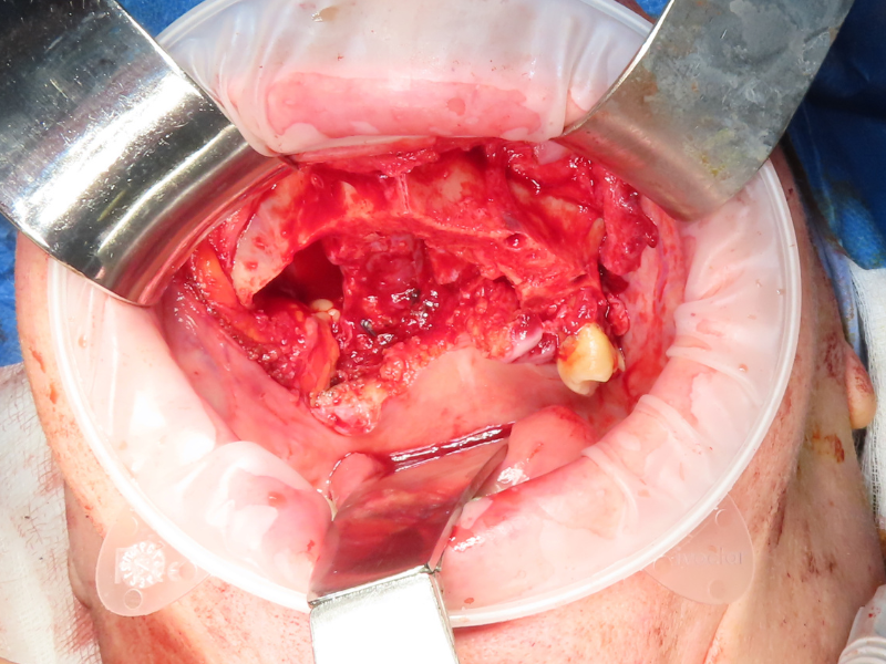 Tumour Resection - Surgical removal of maxillary cancer