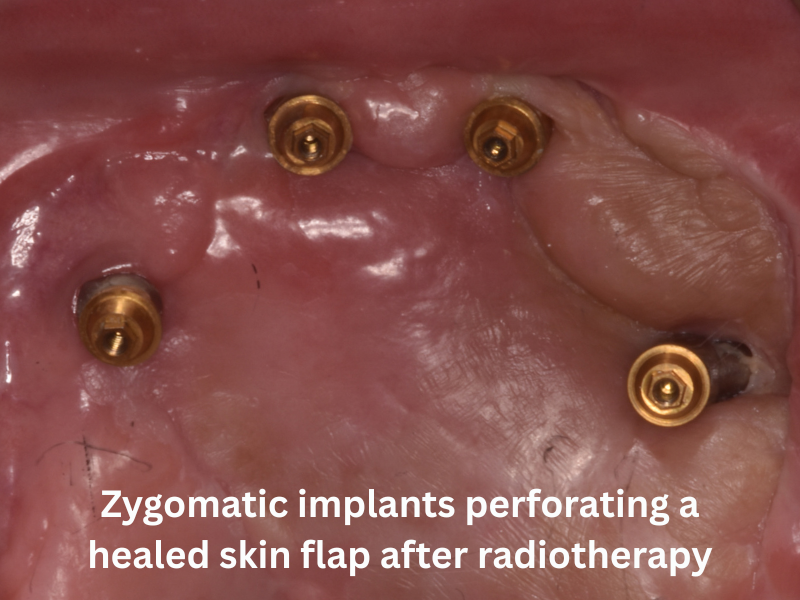 ZIP Flap surgical technique overview