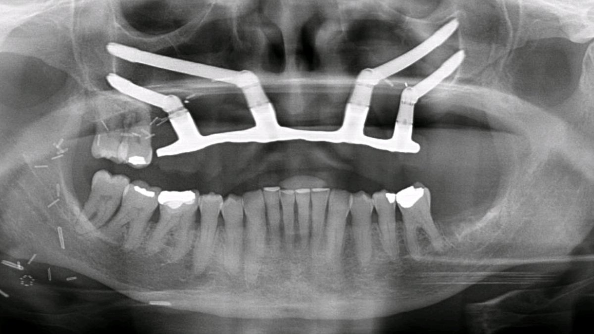 Post-op Radiograph
