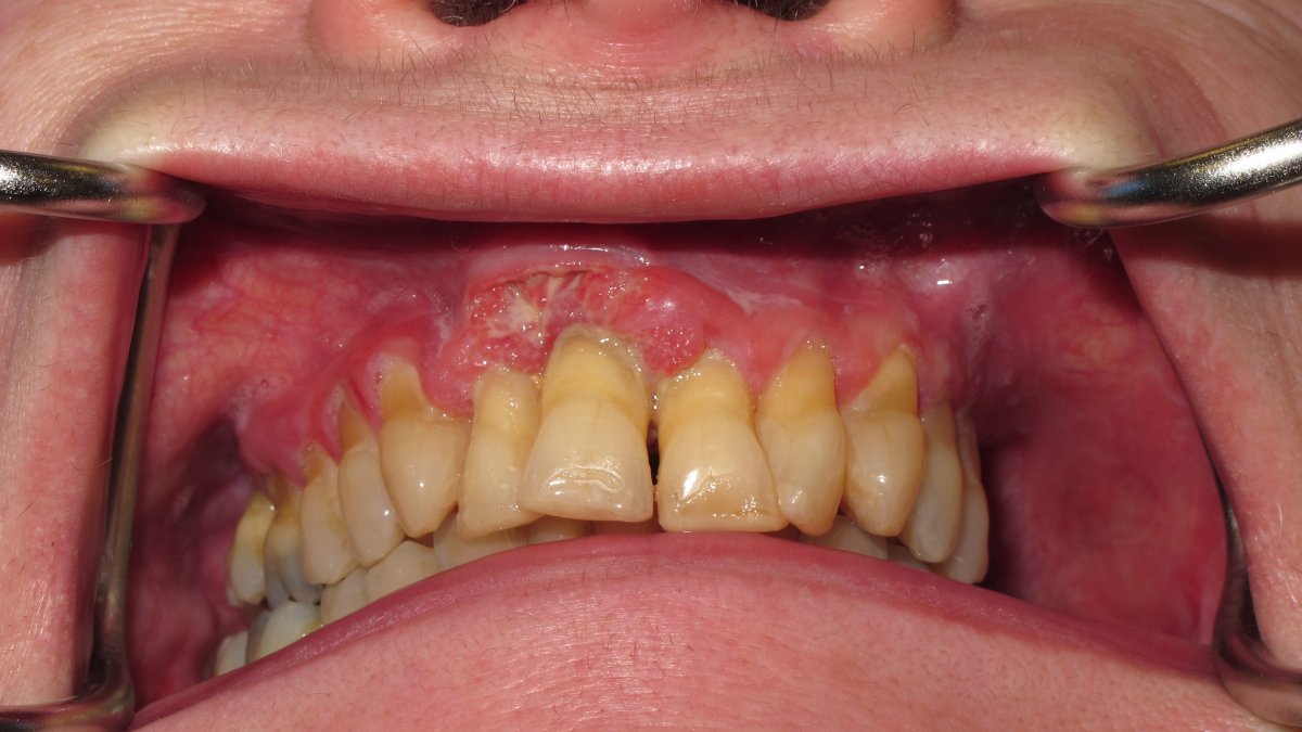 Gingival tumour
