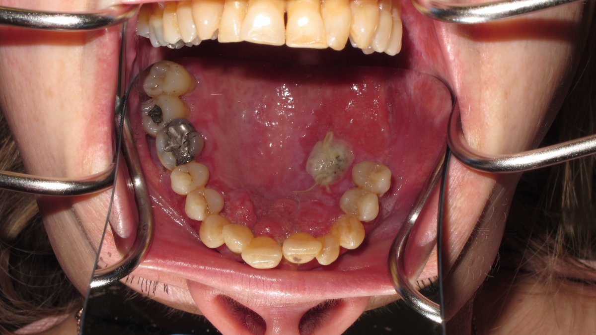 Palatal view