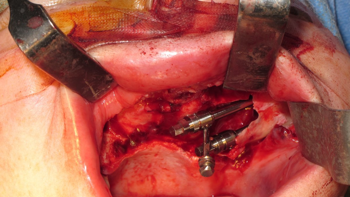 zygomatic implant placement