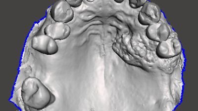 Left Palate tumour with immediate prosthesis at time of surgery