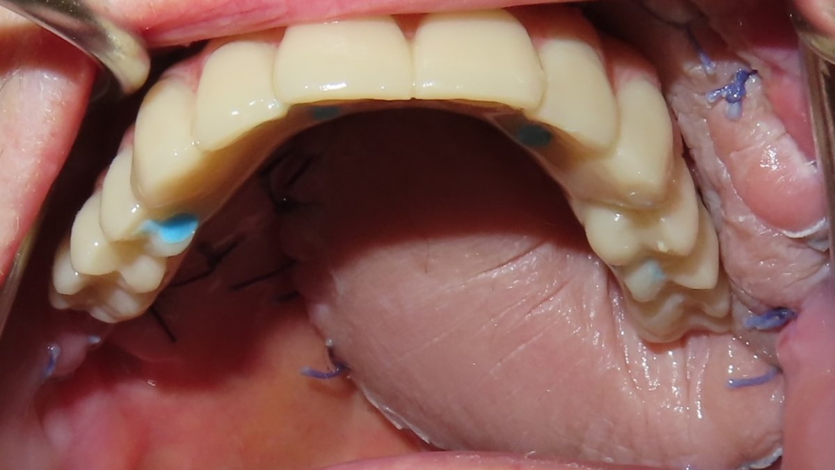 definitive prosthesis fitted