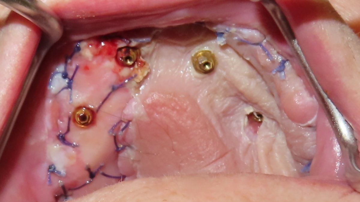 healed flap at 2 weeks