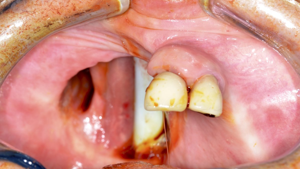 Pre-op maxillary defect