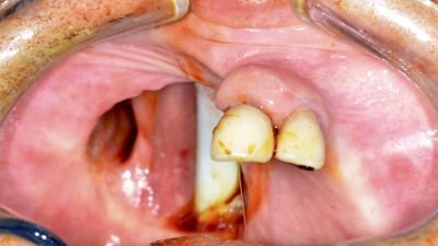 Secondary ZIP Flap to replace obturator