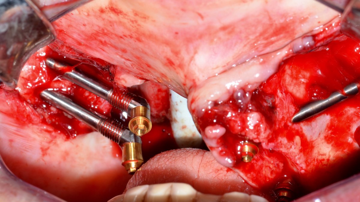 Zygomatic implant placement