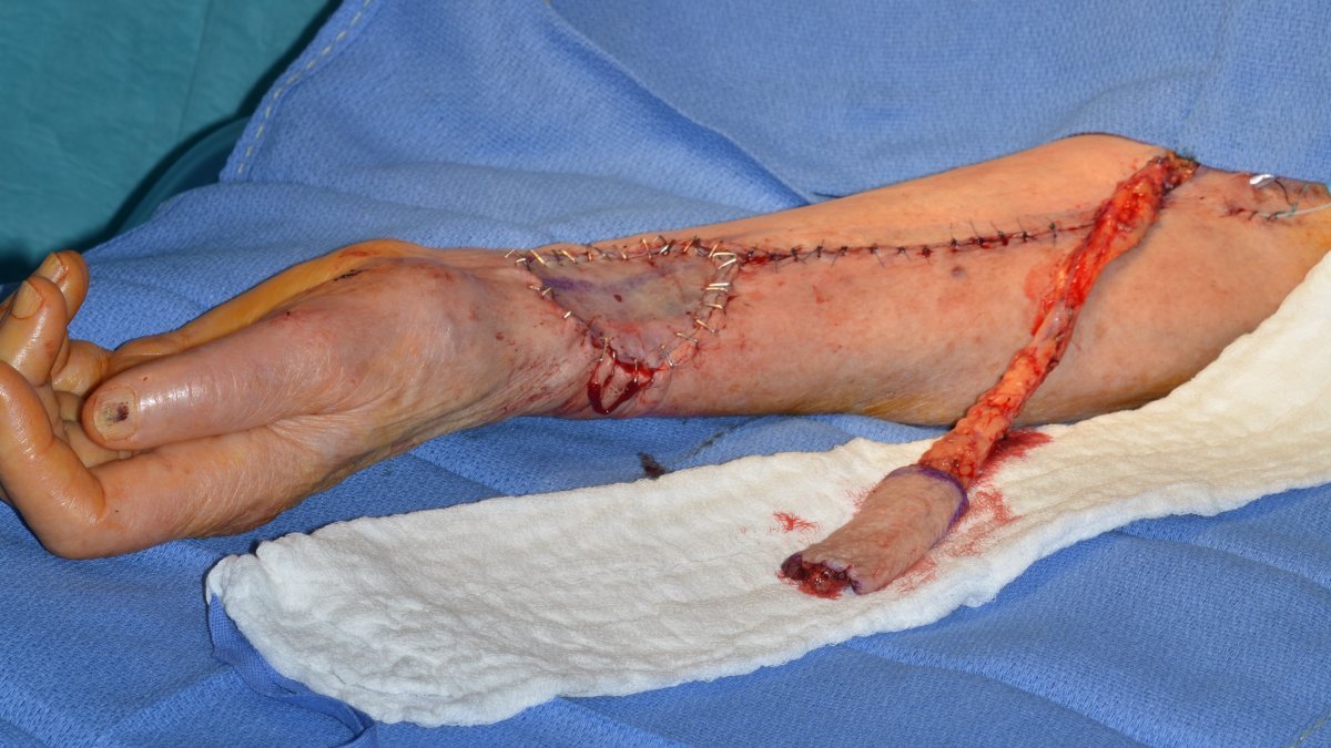 radial forearm flap harvest