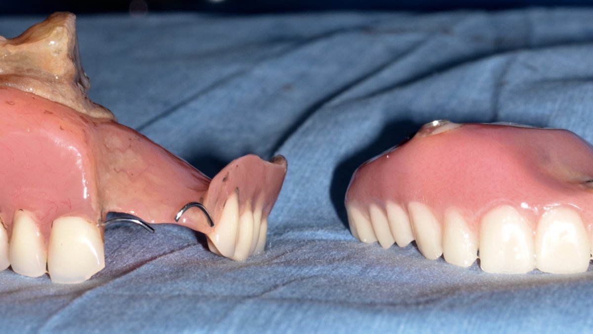 pre-op removable obturator