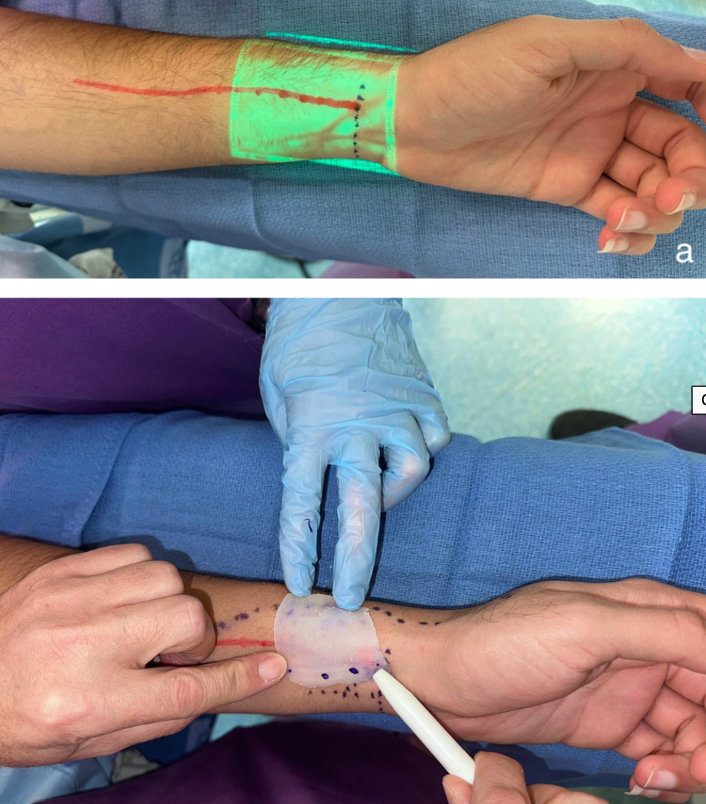 Preoperative Near-Infrared (NIR) Vein Visualization - a novel development in ZIP Flap reconstruction
