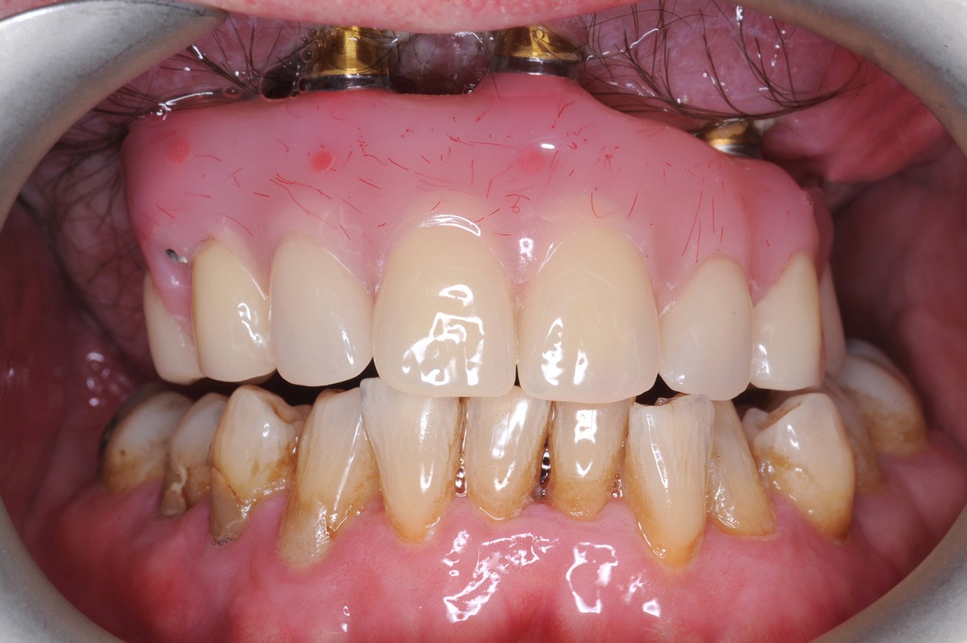 Lancashire and South Cumbria first for Maxillofacial and Restorative Teams at Lancashire Teaching Hospitals
